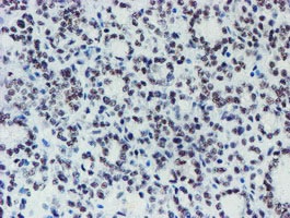 ab128528, at 1/150 dilution, staining METT10D in paraffin-embedded carcinoma of Human thyroid tissue by Immunohistochemistry.