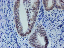 ab128528, at 1/150 dilution staining METT10D in paraffin-embedded adenocarcinoma of Human endometrium tissue by Immunohistochemistry.
