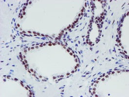 ab128528, at 1/150 dilution staining METT10D in paraffin-embedded carcinoma of Human prostate tissue by Immunohistochemistry.