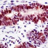 Ab54306 staining human MGMT in human colon carcinoma tissue by immunohistochemistry using formalin fixed, paraffin embedded tissue.