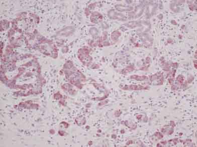 ab58973 staining MIA2 in human pancreatic infiltrating ductal adenocarcinoma tissue by Immunohistochemistry (Formalin-PFA fixed paraffin-embedded sections). The primary antibody was used at 5 ug/ml and incubated with sample at 4°C overnight. A HRP-labeled polymer detection system was used with an alcohol-soluble AEC chromogen. Optimal results were acheived without antigen retrieval step.