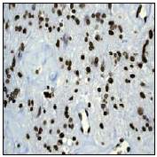 Ab51997 (1:500) staining human histone H4 on human brain glioma by immunohistochemistry using paraffin embedded tissue.Ab51997 (1:500) staining human histone H4 on human brain glioma by immunohistochemistry using paraffin embedded tissue.