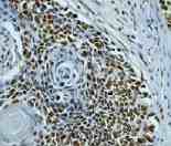 Ab45166 staining human Histone H4 in human cervical carcinoma by immunohistochemistry using paraffin embedded tissue.Ab45166 staining human Histone H4 in human cervical carcinoma by immunohistochemistry using paraffin embedded tissue.