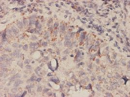 MIF antibody (ab55445) used in immunohistochemistry at 5ug/ml on formalin fixed and paraffin embedded human lung, adenosqumous cell carcinoma tissue.