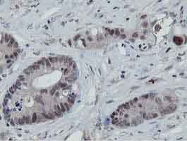 Immunohistochemical analysis of Paraffin-embedded Human colon adenocarcinoma tissue labelling MIPEP with ab131647 at 1/150.