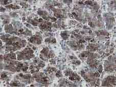 Immunohistochemical analysis of Paraffin-embedded Human liver carcinoma tissue labelling MIPEP with ab131647 at 1/150.