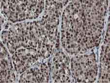 Immunohistochemical analysis of Paraffin-embedded Human thyroid carcinoma tissue labelling MIPEP with ab131647 at 1/150.