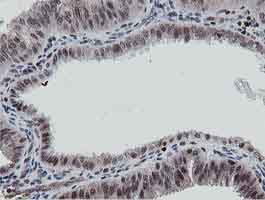 Immunohistochemical analysis of Paraffin-embedded Human endometrium adenocarcinoma tissue labelling MIPEP with ab131647 at 1/150 dilution.