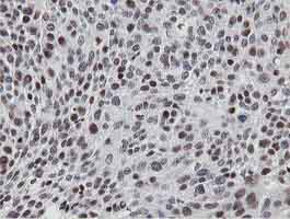 Immunohistochemical analysis of Paraffin-embedded Human bladder carcinoma tissue labelling MIPEP with ab131647 at 1/150 dilution.