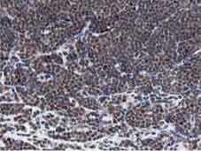 Immunohistochemical analysis of Paraffin-embedded Human lynphoma tissue labelling MIPEP with ab131647 at 1/150 dilution.