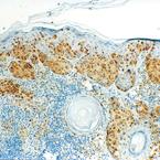 Immunohistochemistry (Formalin/PFA-fixed paraffin-embedded sections) analysis of human malignant melanoma labelling MiTF with ab49387 at 1/10 dilution.