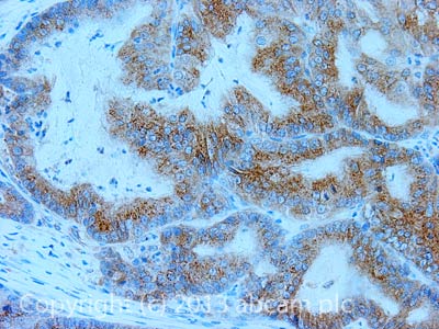 IHC image of Mitofusin 1 staining in Human colon adenocarcinoma formalin fixed paraffin embedded tissue section, performed on a Leica Bond™ system using the standard protocol B. The section was pre-treated using heat mediated antigen retrieval with sodium citrate buffer (pH6, epitope retrieval solution 1) for 20 mins. The section was then incubated with ab107129, 5µg/ml, for 15 mins at room temperature. A Goat anti-Chicken biotinylated secondary antibody was used to detect the primary, and visualized using an HRP conjugated ABC system. DAB was used as the chromogen. The section was then counterstained with haematoxylin and mounted with DPX. For other IHC staining systems (automated and non-automated) customers should optimize variable parameters such as antigen retrieval conditions, primary antibody concentration and antibody incubation times.