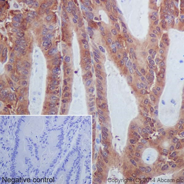 Immunohistochemical analysis of paraffin-embedded Human colonic adenocarcinoma tissue labeling MLKL with ab184718 at 1/400 dilution, followed by Goat Anti-Rabbit IgG H&L (HRP) secondary antibody (ab97051) at 1/500 dilution. Cytoplasmic staining on tumor cells of human colonic adenocarcinoma is observed. Counter stained with Hematoxylin.Negative control: Using PBS instead of primary antibody, secondary antibody is Goat Anti-Rabbit IgG H&L (HRP) (ab97051) at 1/500 dilution.