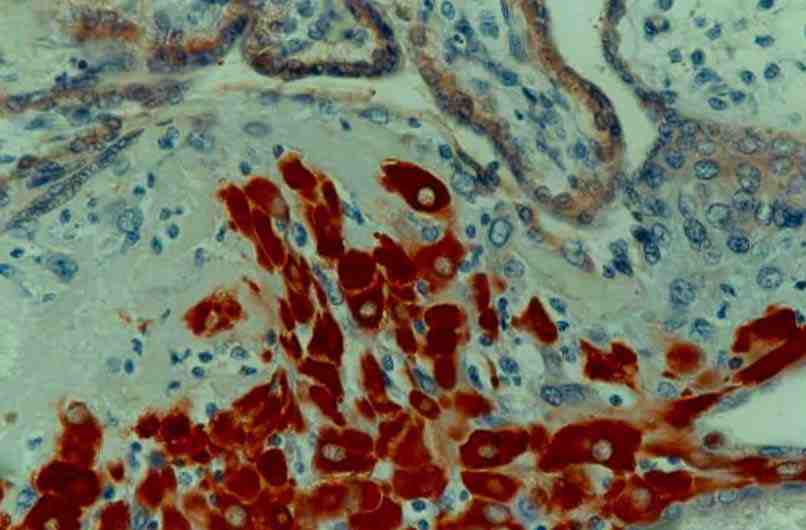 Formalin fixed paraffin embedded human placenta stained with MMP2 using ABC and AEC chromogen.