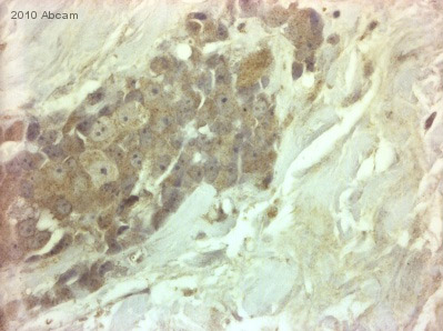 ab63853 staining MMP3 in Human breast carcinoma tissue sections by IHC-P (formaldehyde fixed paraffin embedded sections). Tissue was fixed with formaldehyde and blocked by 5 minutes of peroxidase block then 10 minutes of protein block. Antigen retrieval was by heat mediation in Retrieval solution. Samples were incubated with primary antibody (1/50) for 45 minutes at 20°C. An undiluted HRP-conjugated Goat polyclonal to rabbit IgG was used as secondary antibody.See Abreview