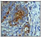 Ab52915 (1:100) staining human MMP3 in human gastric carcinoma tissue by immunohistochemistry using paraffin embedded tissue.
