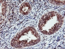 ab119777, at 1/150 dilution, staining Monoacylglycerol Lipase in paraffin-embedded Human endometrium adenocarcinoma tissue by Immunohistochemistry
