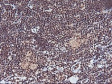 ab119777, at 1/150 dilution, staining Monoacylglycerol Lipase in paraffin-embedded Human lymphoma tissue by Immunohistochemistry.