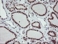 ab119777, at 1/150 dilution, staining Monoacylglycerol Lipase in paraffin-embedded Human thyroid carcinoma tissue by Immunohistochemistry.