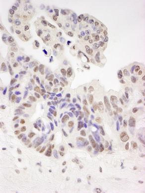 ab87317, at 1/250 dilution, staining HIV TAT specific factor 1 in formalin-fixed, paraffin-embedded human ovarian carcinoma by immunohistochemistry using DAB staining.