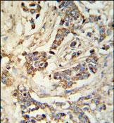 ab103319, at 1/50 dilution, staining MRAP in Human breast carcinoma by immunohistochemistry.