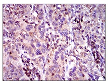 Immunohistochemical analysis of paraffin-embedded Human endometrial cancer tissue labeling MRP4 using ab175364 at 1/200 followed by DAB staining.