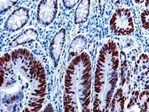 ab14204 staining human colon carcinoma by IHC-P.