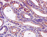 Immunohistochemical analysis of paraffin-embedded Human gastric carcinoma tissue labeling MST4 with ab177153 at 1/50 dilution.
