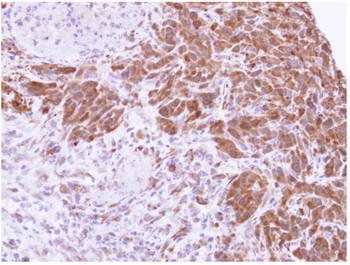 ab96231, at a 1/500 dilution, staining Human MTAP in SAS xenograft, using Immunohistochemistry, Formalin/PFA-fixed paraffin-embedded tissue.