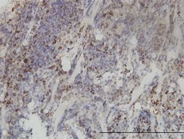 MTHFD2 antibody (ab56772) used in immunohistochemistry at 3ug/ml on formalin fixed and paraffin embedded human lymphoma tissue.
