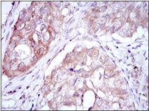 Immunohistochemical analysis of paraffin-embedded human lung cancer using 1/200 ab113637 with DAB staining.
