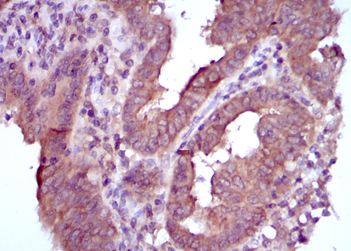 Immunohistochemical analysis of paraffin-embedded human intima cancer tissues using 1/200 ab113637 with DAB staining.