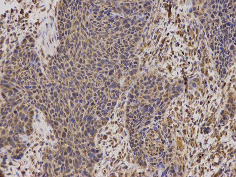 Immunohistochemistry (Formalin/PFA-fixed paraffin-embedded sections) analysis of human esophageal cancer tissue labelling mtTFA with ab180763 at 1/100. Magnification: 200x.