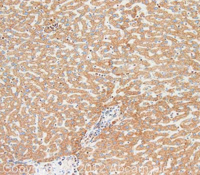IHC image of mtTFA staining in human liver HCC formalin fixed paraffin embedded tissue section, performed on a Leica BondTM system using the standard protocol F. The section was pre-treated using heat mediated antigen retrieval with sodium citrate buffer (pH6, epitope retrieval solution 1) for 20 mins. The section was then incubated with ab119684, 5µg/ml, for 15 mins at room temperature and detected using an HRP conjugated compact polymer system. DAB was used as the chromogen. The section was then counterstained with haematoxylin and mounted with DPX. For other IHC staining systems (automated and non-automated) customers should optimize variable parameters such as antigen retrieval conditions, primary antibody concentration and antibody incubation times.