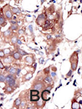 ab5510 staining MUSK in human breast carcinoma (BC) tissue by Immunohistochemistry (Formalin/PFA-fixed paraffin-embedded sections).