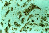 ab2376 - immunohistochemistry Formalin fixed paraffin embedded human breast carcinoma stained with MVP, using ABC and DAB chromogen.