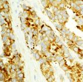 ab54301 staining human MVP in human breast carcinoma tissue by immunohistochemistry using formalin fixed, paraffin embedded tissue.