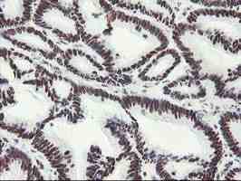 ab128108, at 1/150 dilution, staining Myeloid leukemia factor 1 in paraffin-embedded Human colon adenocarcinoma tissue by Immunohistochemistry.