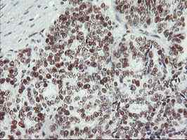 ab128108, at 1/150 dilution, staining Myeloid leukemia factor 1 in paraffin-embedded Human ovary adenocarcinoma tissue by Immunohistochemistry.