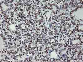 ab128108, at 1/150 dilution, staining Myeloid leukemia factor 1 in paraffin-embedded Human thyroid carcinoma tissue by Immunohistochemistry.