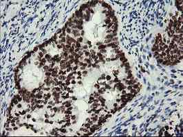 ab128108, at a dilution of 1/150, staining Myeloid leukemia factor 1 in paraffin-embedded Adenocarcinoma of Human endometrium tissue by Immunohistochemistry.