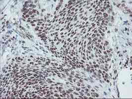 ab128108, at 1/150 dilution, staining Myeloid leukemia factor 1 in paraffin-embedded Human bladder carcinoma tissue by Immunohistochemistry.