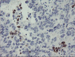 Immunohistochemical analysis of paraffin-embedded Human ovary adenocarcinoma tissue labelling MYL7 with ab131661 at 1/150 dilution.