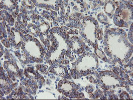 Immunohistochemical analysis of paraffin-embedded Human thyroid carcinoma tissue labelling MYL7 with ab131661 at 1/150 dilution.