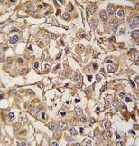 Formalin-fixed and paraffin-embedded human breast carcinoma tissue reacted with MYLK3 antibody (N-term) (ab71826), which was peroxidase-conjugated to the secondary antibody, followed by DAB staining.