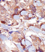 ab71826 at 1/50 dilution, staining Myosin light chain kinase in human breast carcinoma by Immunohistochemistry using formalin-fixed, paraffin-embedded tissue, followed by peroxidase-conjugated secondary antibody and DAB staining.