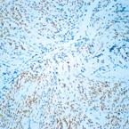 Ab49476, at a dilution of 1/20, staining MyoD1 in paraffin sections of human rhabdomyosarcoma by Immunohistochemistry. Note staining of a proportion of tumor cell nuclei.