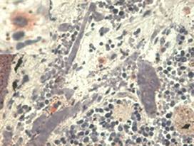 The antibody ab7759 stains infiltrating macrophages in pulmonary diseases. In the top left corner see detail of macropage. 