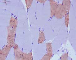 ab86593, at a 1/200 dilution, staining paraffin embedded Myosin light chain 3 in human cardiac muscle tissue by Immunohistochemistry, followed by DAB staining.