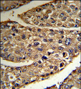 ab102769 at 1/50 dilution staining N myc interactor in Human hepatocarcinoma tissue by Immunohistochemistry. Formalin-fixed, Paraffin-embedded tissue. Detection: DAB staining
